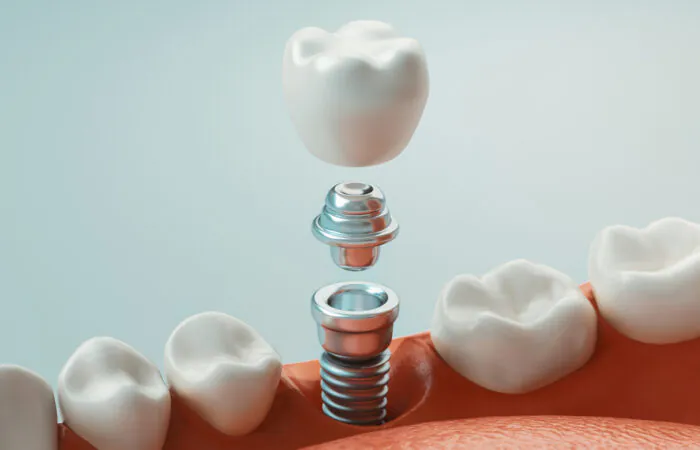 Aesthetic & Implant Crowns