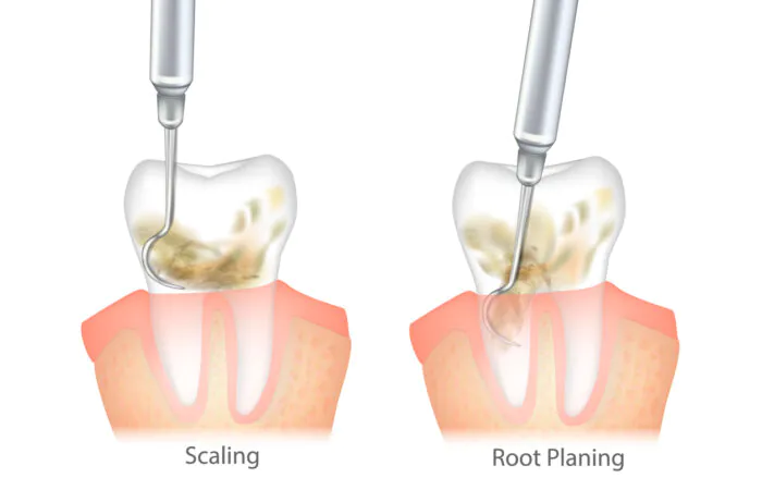Scaling & Root Planing