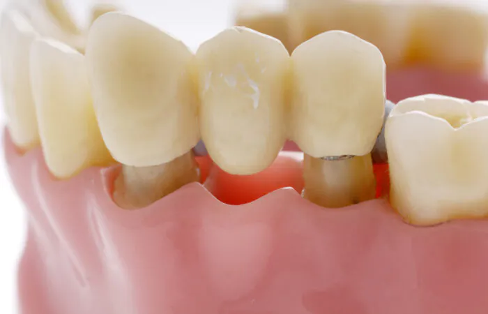 Dental Bridges